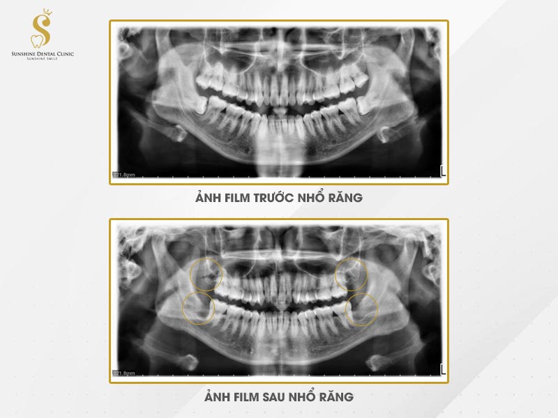 Hình ảnh film chụp trước và sau khi nhổ răng của khách hàng