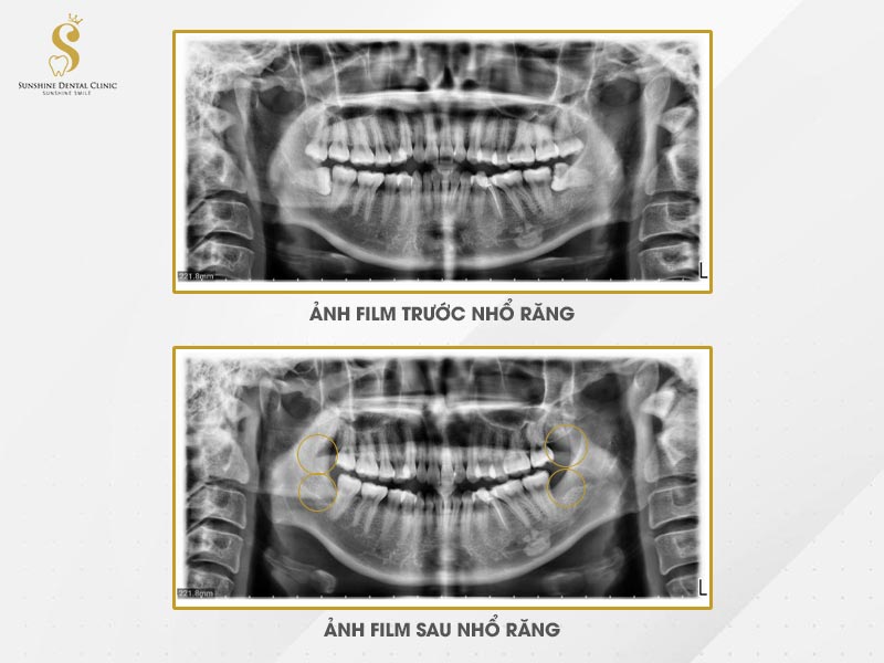 Hình ảnh film trước và sau khi nhổ răng khôn của khách hàng