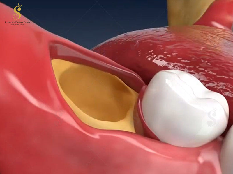 Hình ảnh huyệt ổ răng sau khi loại bỏ thành công chiếc răng khôn ra khỏi cung hàm: