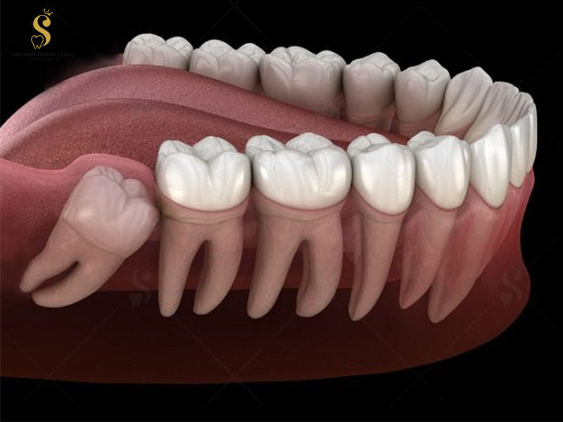 Hình ảnh mô phỏng răng khôn trước khi được nhổ bỏ: