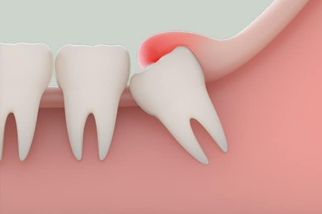 Nhổ răng khôn có đau không? Cách khắc phục được cơn đau sau nhổ?