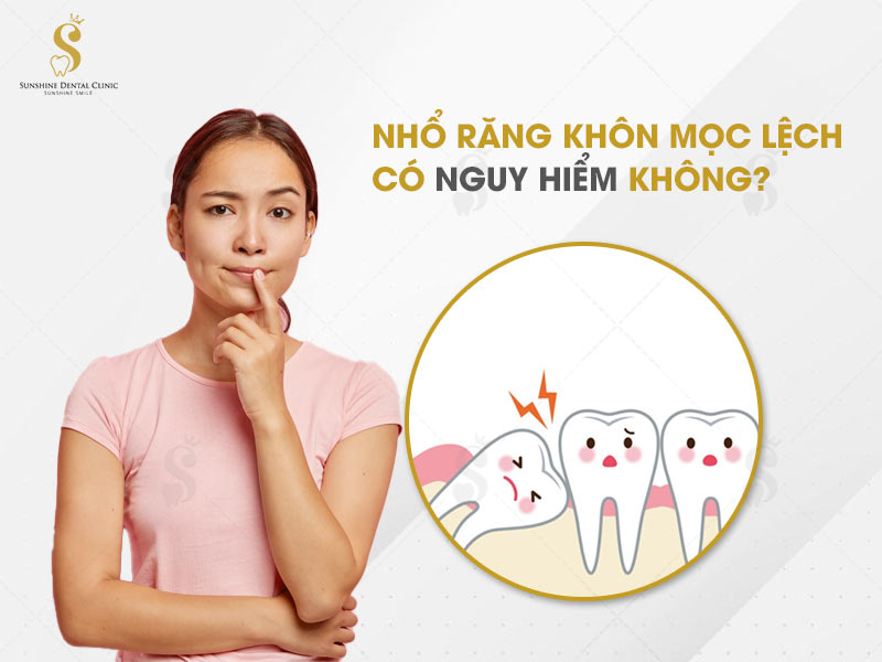 Nhổ răng khôn mọc lệch có nguy hiểm không sẽ phụ thuộc vào nhiều yếu tố