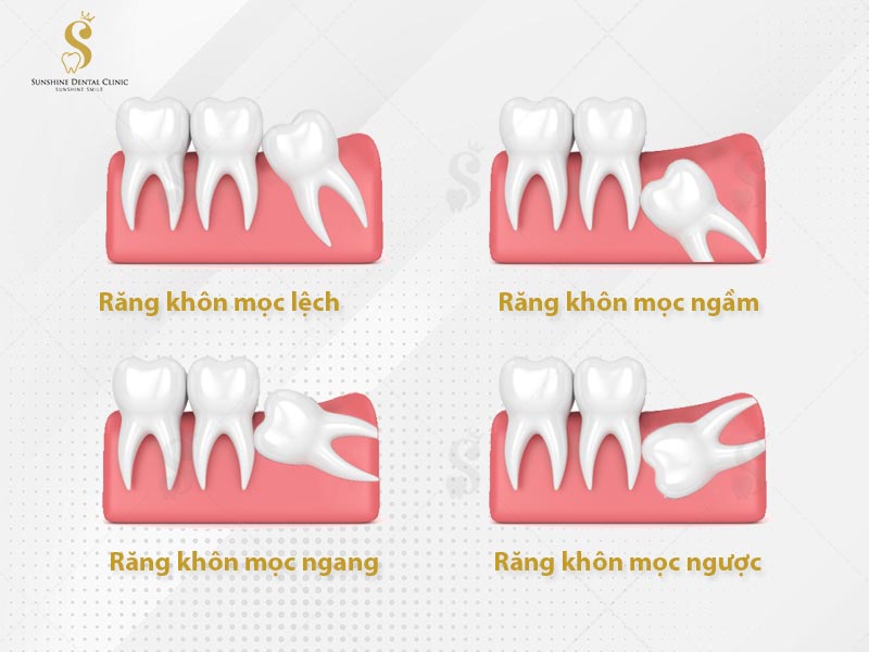 Răng khôn mọc bất thường, gây nhiều biến chứng thì chi phí nhổ răng khôn sẽ cao