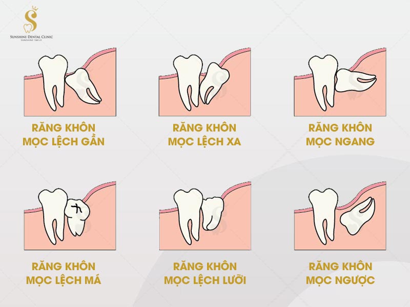 Răng khôn mọc bất thường sẽ tác động tới chi phí nhổ răng