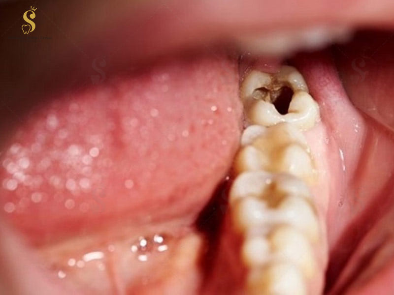 Nhổ răng khôn hàm dưới bị sâu càng sớm càng tốt