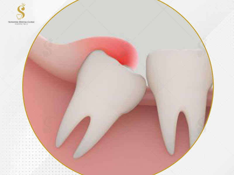 Viêm lợi trùm – Biến chứng nguy hiểm bạn có thể gặp phải khi mọc răng khôn