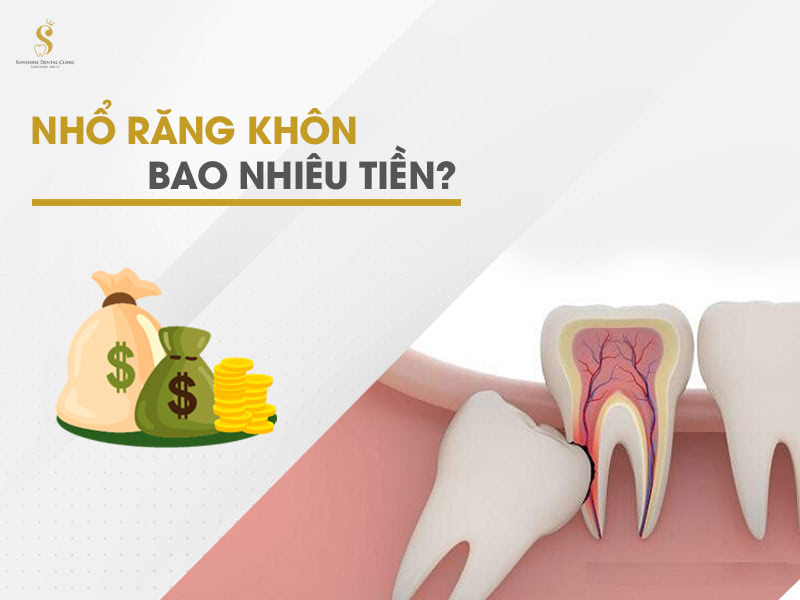 Nhổ răng khôn bao nhiêu tiền sẽ tùy thuộc vào từng trường hợp cụ thể