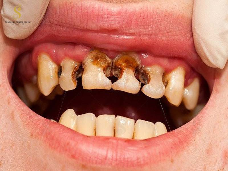 Răng sâu - Hiện tượng rất hay gặp ở người bị tiểu đường
