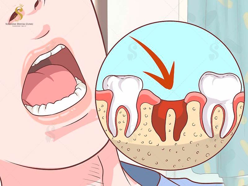 Chảy máu sau khi nhổ răng có rất nhiều nguyên nhân gây nên