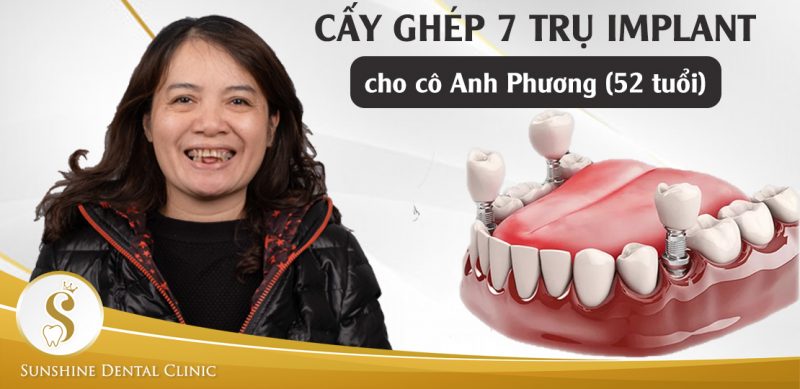 CAY-GHEP-7-TRU-IMPLANT-cho-co-anh-phuong