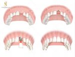 Cách trồng răng implant răng cửa