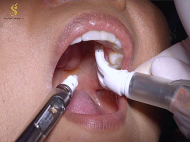 Gây tê niêm mạc khi nhổ răng giúp giảm đau hiệu quả
