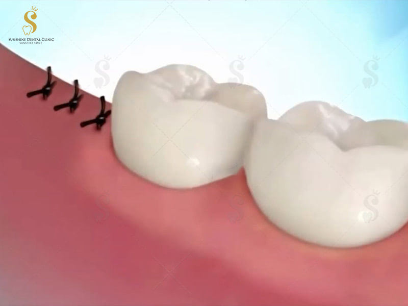 Quên cắt chỉ sau khi nhổ răng khôn sẽ rất nguy hiểm