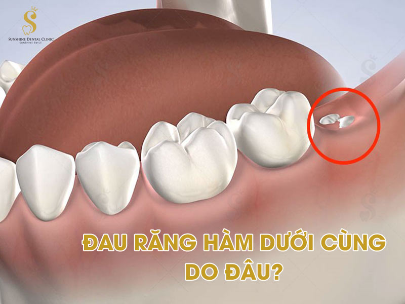 Răng khôn mọc là nguyên nhân gây đau răng hàm dưới trong cùng