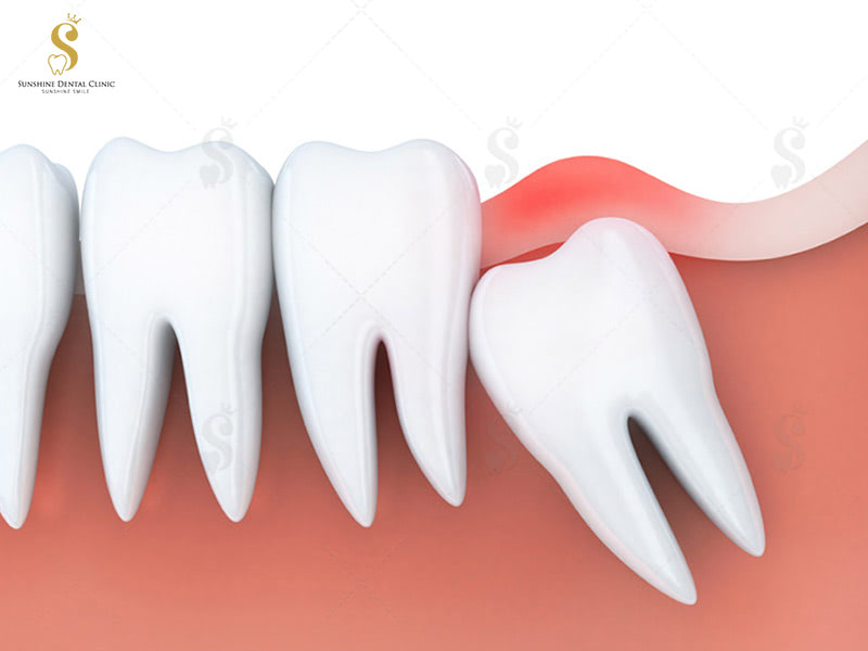Răng khôn mọc sẽ gây hiện tượng đau răng hàm trong cùng