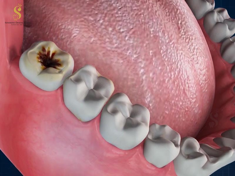 Sâu răng là một trong những lý do gây tình trạng đau nhức răng hàm