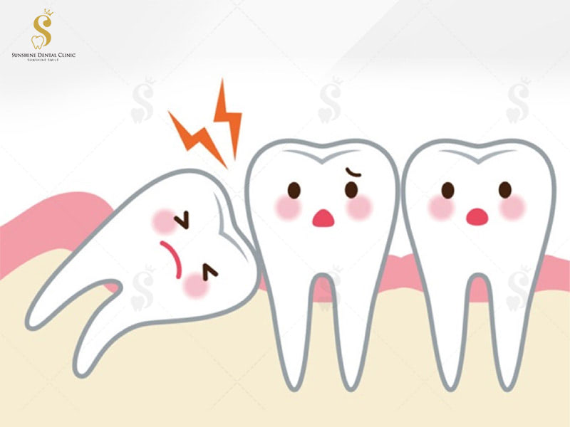 Răng khôn mọc – Nỗi ám ảnh của chúng ta