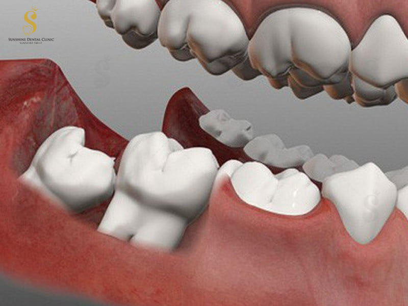 Răng mọc bất thường cần sớm loại bỏ để ngăn chặn biến chứng nguy hiểm