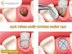 qua-trinh-ghep-xuong-rang-implant