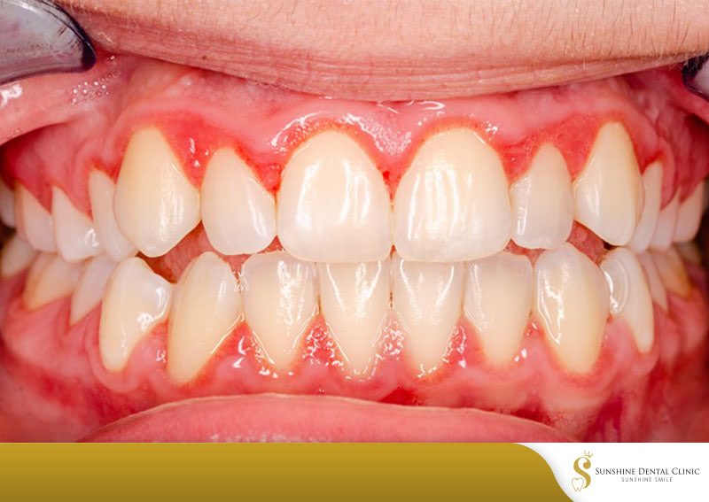 Viêm nướu răng - Bệnh lý phổ biến ở mọi lứa tuổi