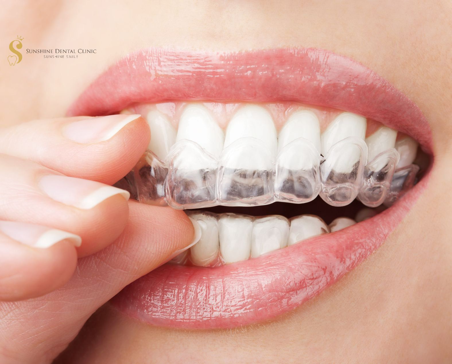 Niềng răng trong suốt điều trị răng hô nhẹ
